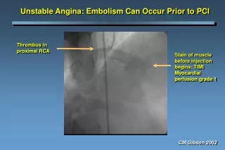 Unstable Angina: Embolism Can Occur Prior to PCI