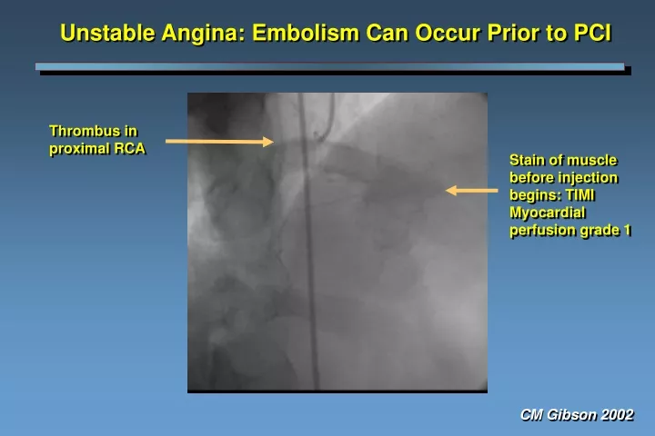 unstable angina embolism can occur prior to pci