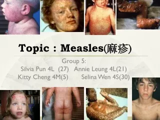 Topic : Measles ( 麻疹 )