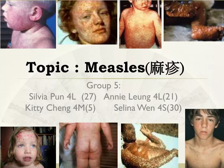 topic measles