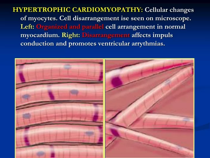 hypertrophic cardiomyopathy cellular changes