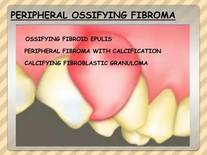 peripheral ossifying fibroma