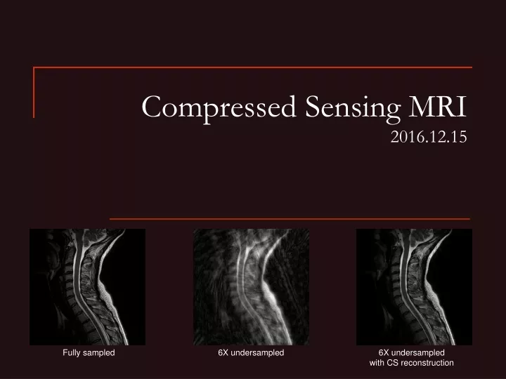 compressed sensing mri 2016 12 15