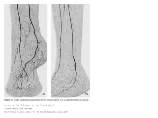 Dohmen, A; Eder, S;  Euringer , W; Zeller, T;  Beyersdorf , F Chronic  Critical  Limb Ischemia