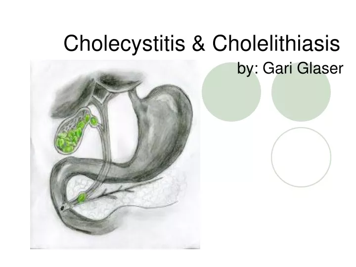 cholecystitis cholelithiasis