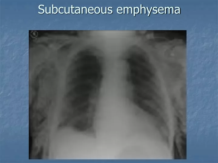 subcutaneous emphysema