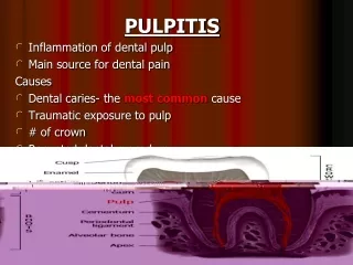PULPITIS Inflammation of dental pulp Main source for dental pain Causes
