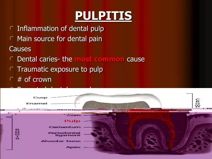 pulpitis inflammation of dental pulp main source