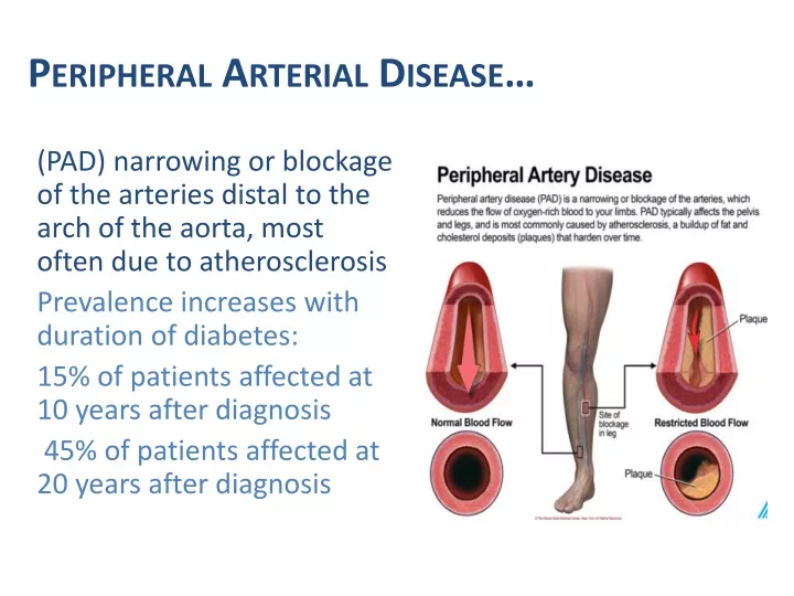 peripheral arterial disease