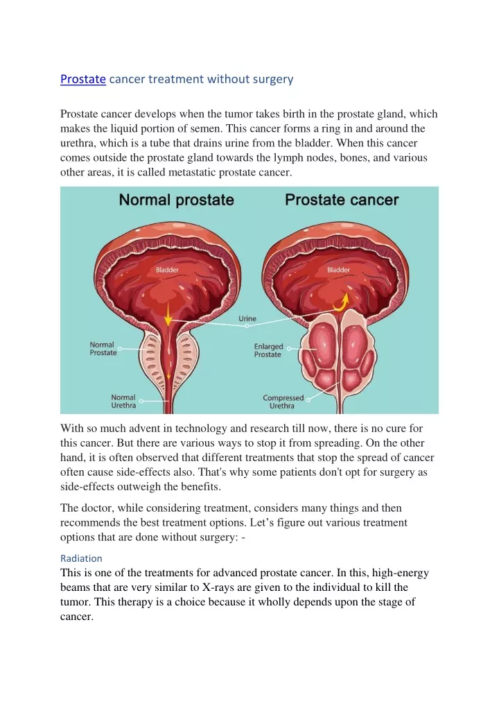 prostate cancer treatment without surgery