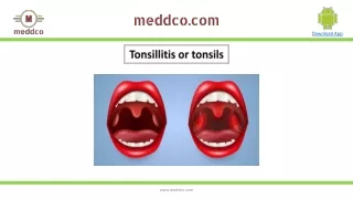 Tonsillitis types,Causes,Symptoms,Diagnosis,Prevention and treatment