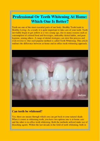 Professional Or Teeth Whitening At Home: Which One Is Better?