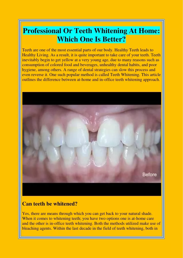 professional or teeth whitening at home which