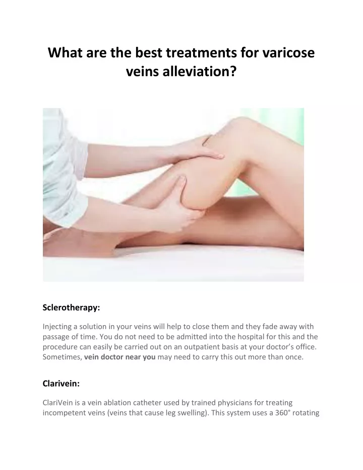 what are the best treatments for varicose veins