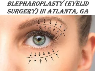 Blepharoplasty Atlanta, GA | Buckhead Blepharoplasty (Eyelid Surgery)