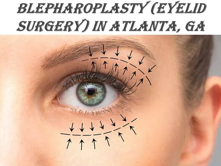 blepharoplasty eyelid surgery in atlanta ga