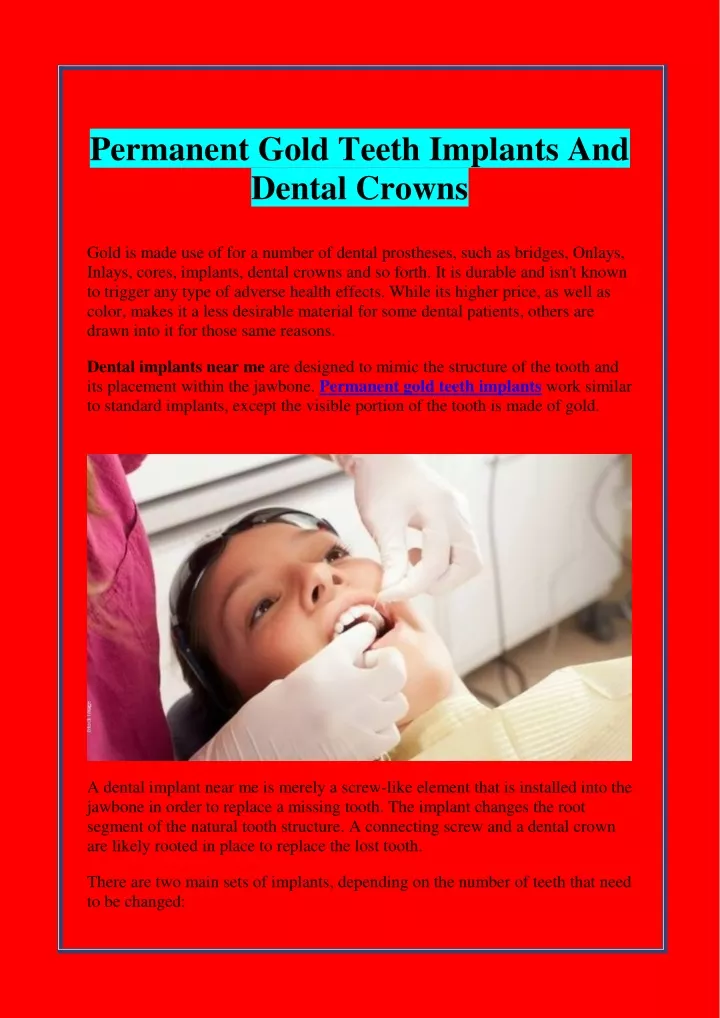 permanent gold teeth implants and dental crowns