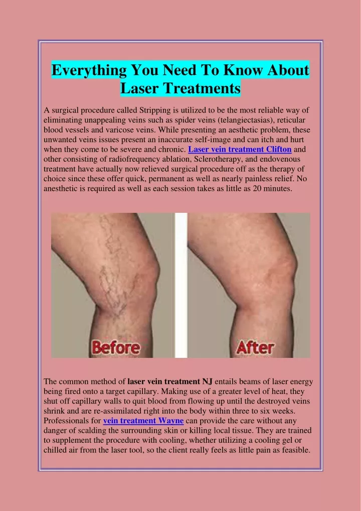 everything you need to know about laser treatments