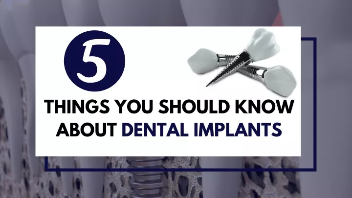 things you should know about dental implants