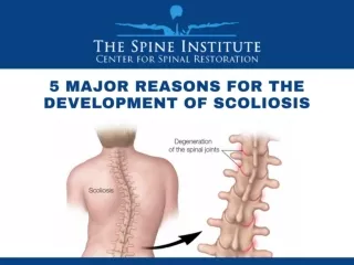 Top 5 Causes of Scoliosis