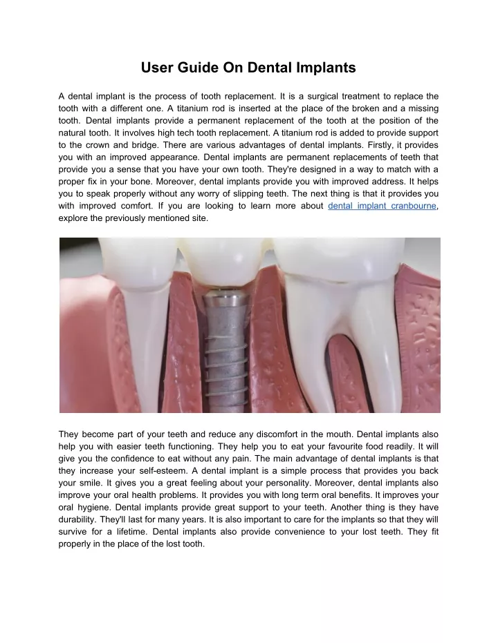 user guide on dental implants