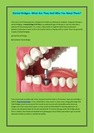 Dental Bridges What Are They And Why You Need Them