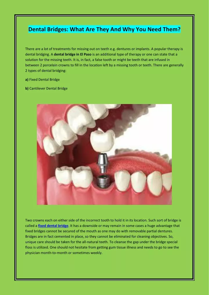 dental bridges what are they and why you need them
