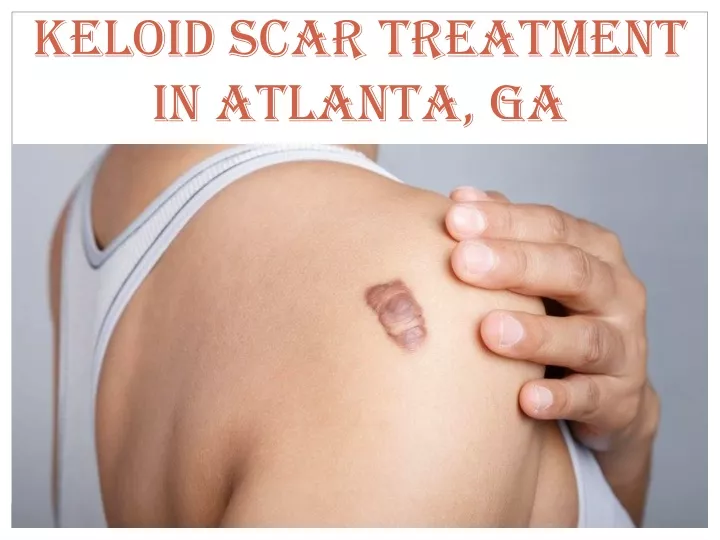 keloid scar treatment in atlanta ga