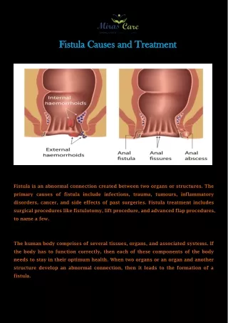 Fistula Causes and Treatment