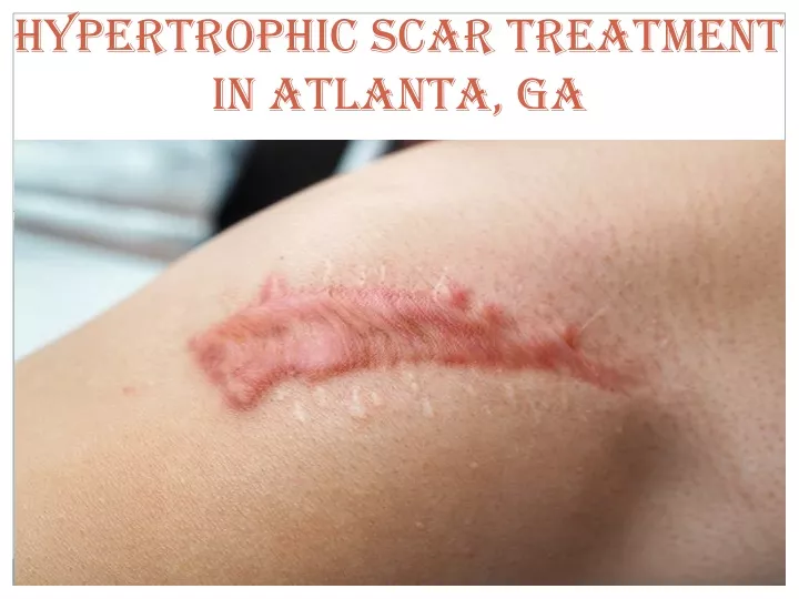 hypertrophic scar treatment in atlanta ga