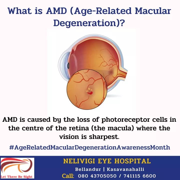 what is amd age related macular degeneration