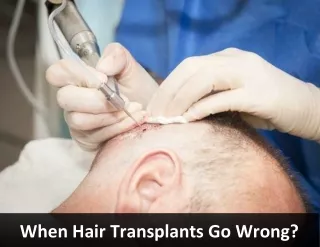 When Hair Transplants Go Wrong?