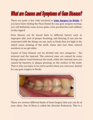 Get comfortable Gum Surgery in Noida only from Floss Dental