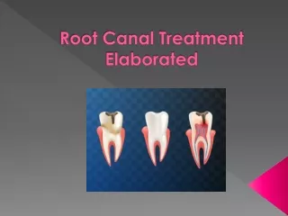 Root Canal Treatment Elaborated