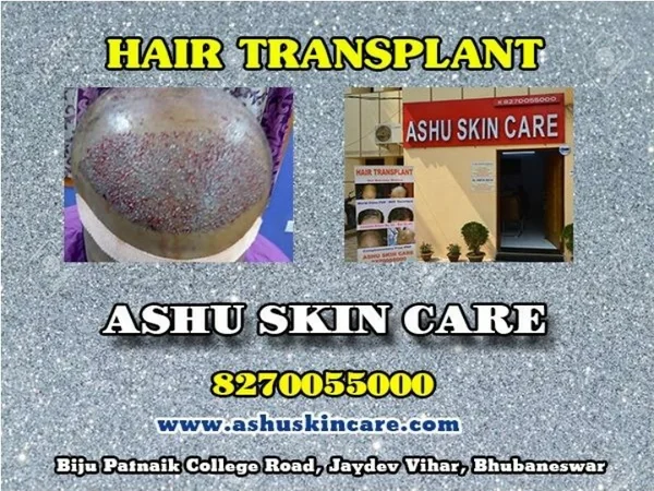Ashu skin care best hair transplant clinic in bhubaneswar odisha