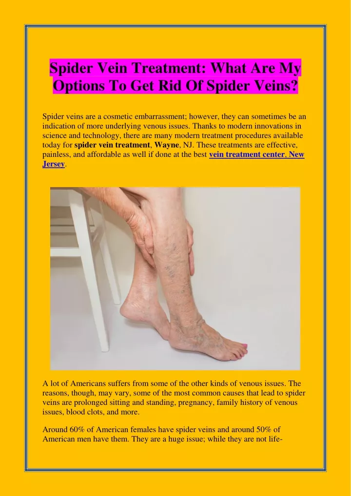 spider vein treatment what are my options