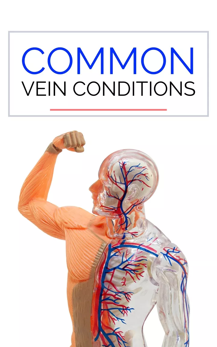 common vein conditions