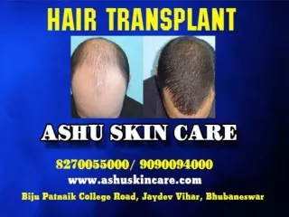 Ashu skin care - Top clinic for hair transplant in Bhubaneswar Odisha