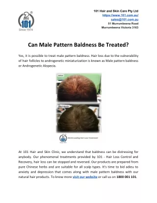 Can Male Pattern Baldness Be Treated?