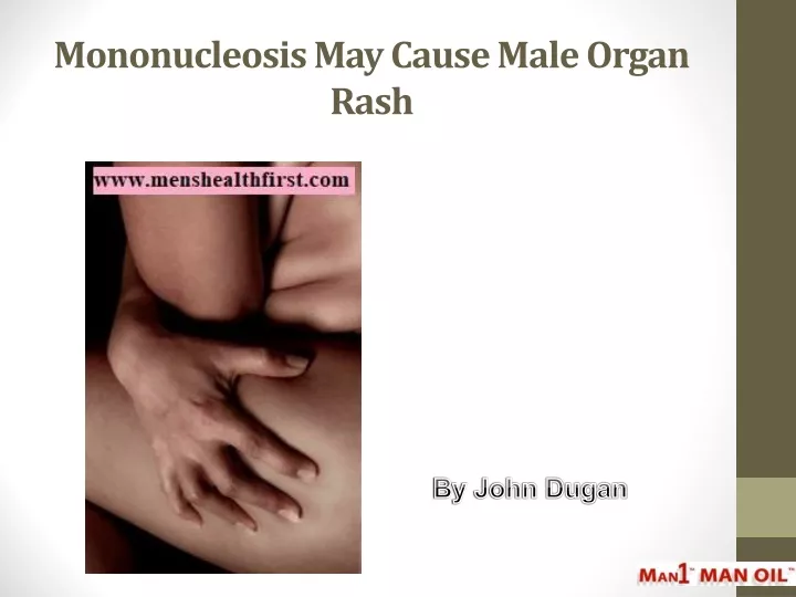 mononucleosis may cause male organ rash