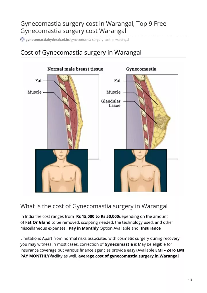 gynecomastia surgery cost in warangal top 9 free