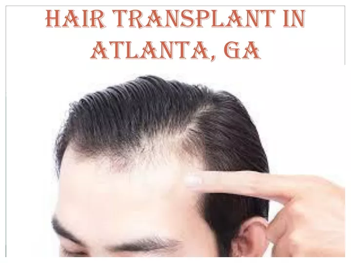 hair transplant in atlanta ga