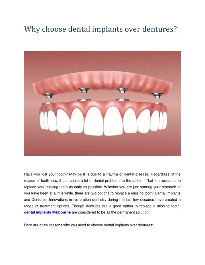 why choose dental implants over dentures