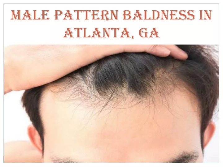 male pattern baldness in atlanta ga