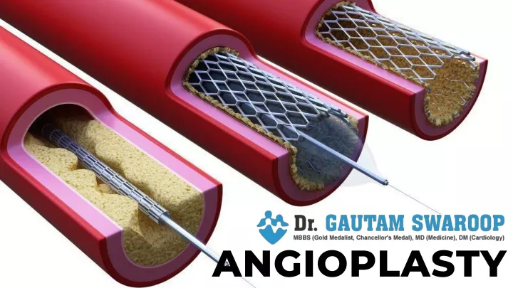 angioplasty