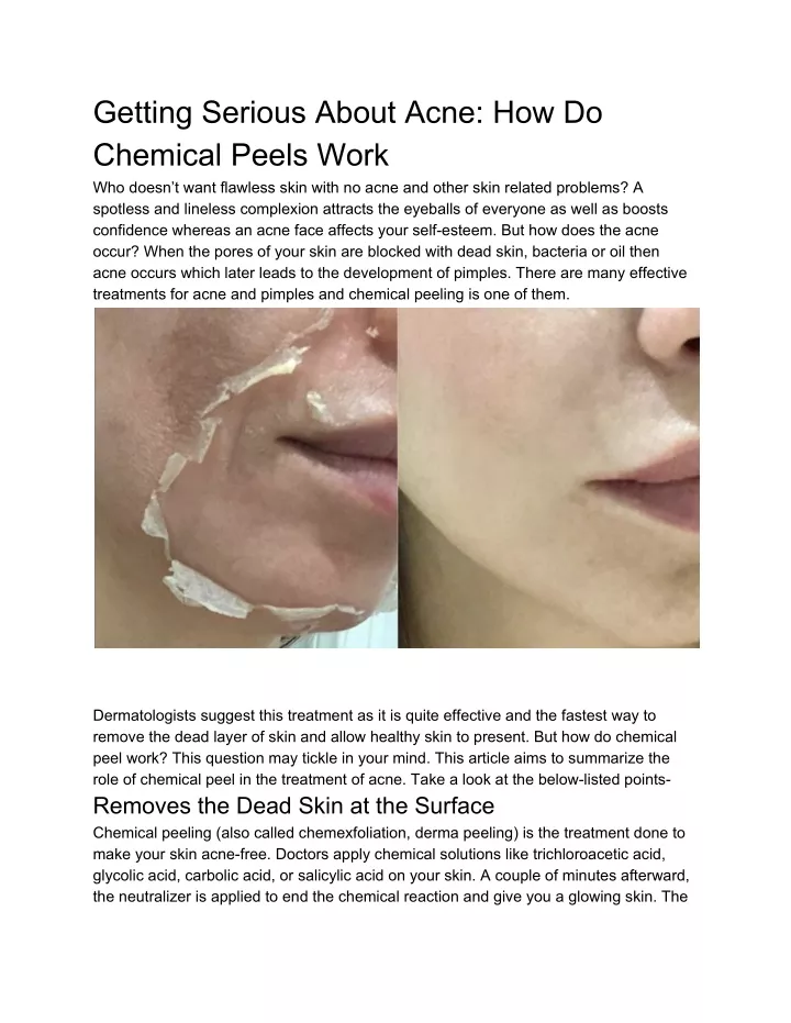 getting serious about acne how do chemical peels