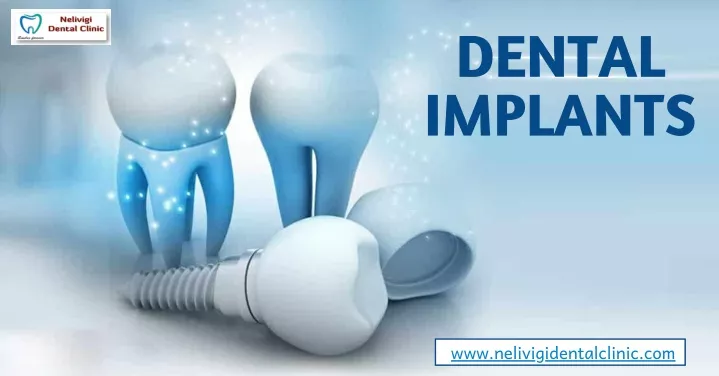 dental implants