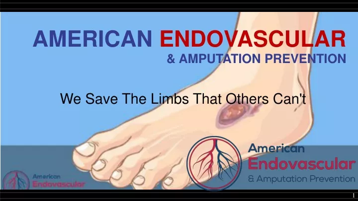 american endovascular amputation prevention