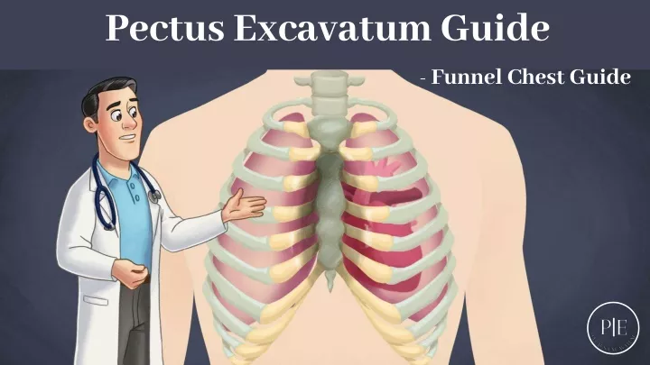 pectus excavatum guide