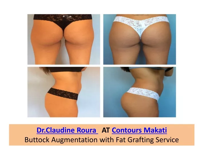 dr claudine roura at contours makati buttock